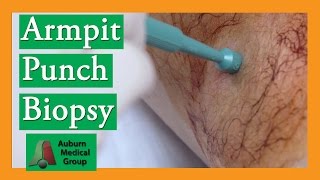 Armpit Sebaceous Cyst Punch Biopsy Removal  Auburn Medical Group [upl. by Alym]