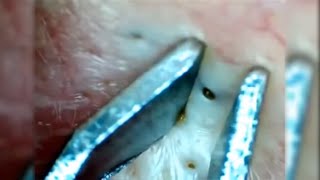 Squeeze blackheads on the skin of patients [upl. by Readus]