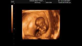 Amazing Dancing Baby in the Womb 11 Weeks [upl. by Atinniuq]