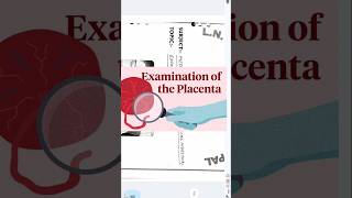 Placental examination demo fetal surface maternalumbilical cord examinationProcedure [upl. by Dercy]