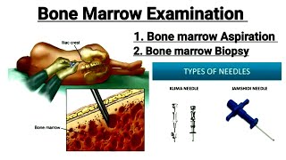 Bone Marrow Examination  Bone marrow Aspiration  Bone marrow biopsy in hindi [upl. by Kcirtemed420]