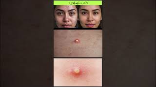 what are pimples and how pimples are formed  pimples kun banty hain  Health amp Care health [upl. by Giorgi]