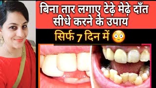 टेढ़े मेढ़े दांत को सीधा कैसे करें बिना तार के बाहर निकले दांतो को अंदर करे  Crooked teeth tt [upl. by Fonsie]