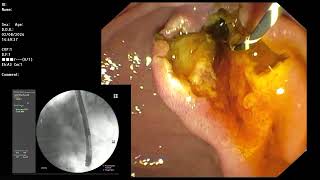 ERCP  Papillitis from recently passed CBD stone [upl. by Yntirb428]