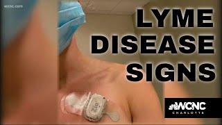 Do you know the signs of Lyme disease [upl. by Tut]