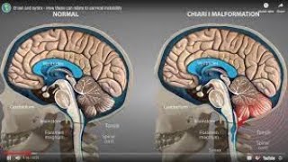 Chiari Malformation Type 1  Symptoms that you may have Chiari Malformation Over Fifty [upl. by Gemoets]