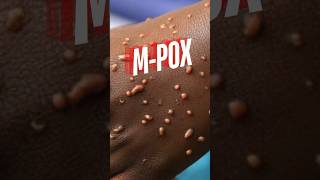 MPOX Outbreak What You Need to Know monkey pox mpox virus viralvideo shorts [upl. by Carvey]