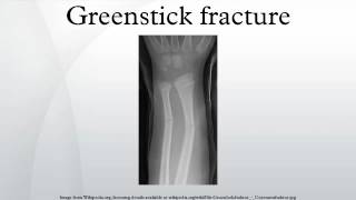 Green stick fracture [upl. by Evot177]