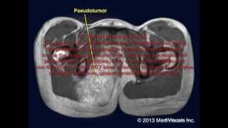 MetalonMetal Hip Vol 25 Complications Pseudotumor Formation [upl. by Aicilic362]