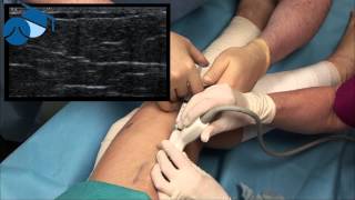 Foam sclerotherapy treatment of feeder veins varicose veins [upl. by Annohs]