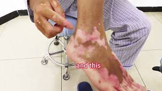 MCDR Treatment for Vitiligo 2024 [upl. by Felicie384]