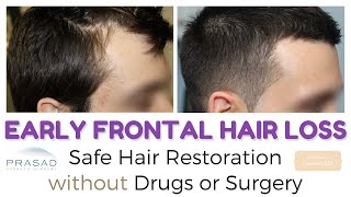 Frontal Hair Loss at 20  Managing Hair Loss and Hair Thinning Safely without Surgery [upl. by Tarton]