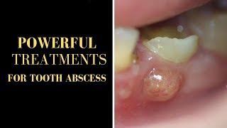 Tooth Abscess Treatment GOLDEN TECHNIQUE TO CURE TOOTH ABSCESS NATURALLY IN RECORD TIME [upl. by Sylera]