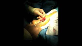 Achilles Tendon Rupture Repair Surgery  Houston Foot Surgeon [upl. by Kitchen679]