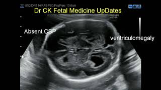 Absent CSP ventriculomegaly [upl. by Ecienaj]