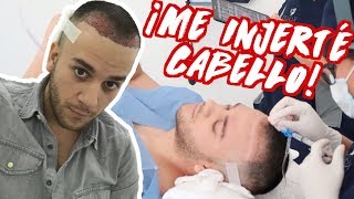 ¡MI OPERACIÓN DE TRANSPLANTE DE CABELLO 😱  Beto Pasillas [upl. by Sarah]