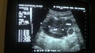 ultrasound  COMPLEX MASS RT ADNEXA [upl. by Haim]