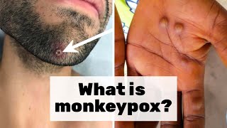 Epidemiologist Answers Common Monkeypox Questions  WIRED [upl. by Nauqyt532]