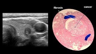 ENGthyroid FNA2technique2 [upl. by Nitnerb]