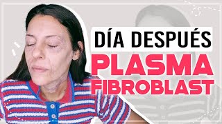 PLASMA PEN FIBROBLAST día 1 plasma pen antes y después plasmafibroblast carolinatv CarolinaSKB [upl. by Anerb113]