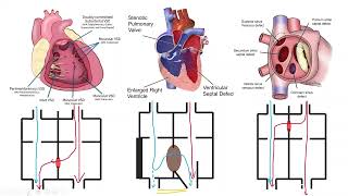 Infective Endocarditis in Pediatrics 8 [upl. by Eiddal]