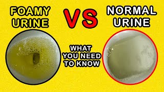 Foamy Urine vs Normal Urine What is the difference and causes [upl. by Airtal]