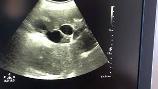 Dilated intrahepatic biliary radicles lab report is uploades in other video [upl. by Harpole]