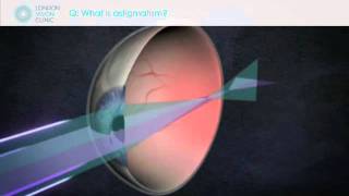 What is astigmatism [upl. by Eeleimaj]