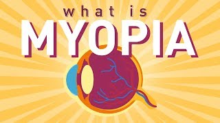 What is Myopia Short sightedness [upl. by Tammy564]