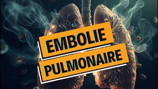 EMBOLIE PULMONAIRE et PHLEBITE  tout comprendre  WhyDoc 1 [upl. by Mazman]