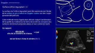 insuffisance aortique [upl. by Ardnekan]