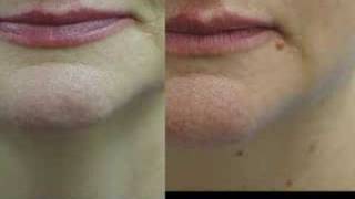 Erbium Laser Resurfacing Before and After Phots [upl. by Rivi]