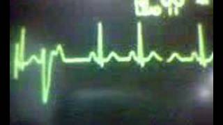 ECG Video Ectopics  Ventricular unifocal [upl. by Kate]