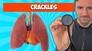 Fine and Coarse Crackles Lung Sounds For Beginners 🔥🔥🔥 [upl. by Assilaj]