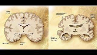 Pathology of Dementia and Degenerative Disorders Pathoma Lectures word by word explained [upl. by Eitak825]