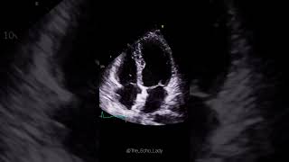 Closure device in situ 🩵🫀 cardiology amplatzer cardiologia echocardiogram [upl. by Lunseth]