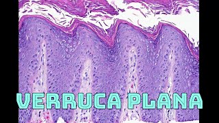 Verruca plana flat wart under microscope histology pathology dermatology [upl. by Aratehs]