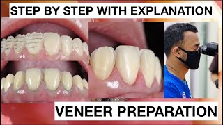 Step by Step Minimally Invasive Veneers Preparation  General Dentist Griya RR [upl. by Louanne]