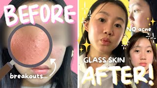 HOW I GOT RID OF MY ACNE  my 1 product for acne skincare routine extra tips [upl. by Etennaej234]