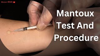 Mantoux test  Procedure  Positive results  Negative results [upl. by Eocsor670]