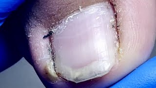 Be Careful When Removing An Ingrown Toenail [upl. by Estis]