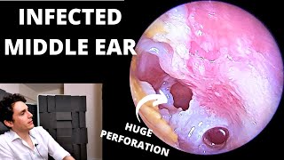 The Worst Ear Infection Suppurative Otitis Media [upl. by Ennire]