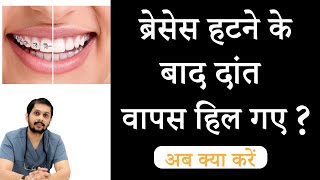 Relapse after braces  ब्रेसेस हटने के बाद दांत हिलने लगे  Best braces treatment in Indore [upl. by Arama]