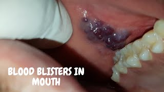 Blood blisters in mouth Angina bullosa hemorrhagicaमुँह के छाले  कारण [upl. by Dyann857]