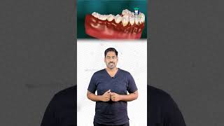 கர்ப்ப காலத்தில் கிளிப் போடலாமா Braces During Pregnancy DrKarthikeyan Denta Kings shorts [upl. by Dorrej234]