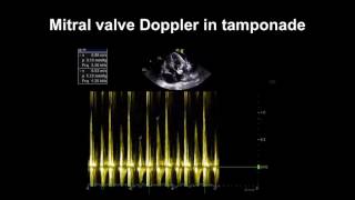 Echocardiography Essentials Detecting pericardial effusions [upl. by Aerbua]