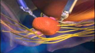 Intuitive Surgery video on Prostatectomy [upl. by Neladgam]