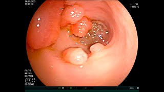 Chronic vomiting in a cat due to antral pyloric polyps Polypectomy [upl. by Renault81]