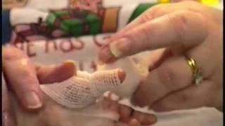 ABCs Hand Wrapping Technique Epidermolysis Bullosa [upl. by Derward]