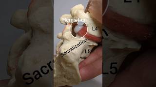 Disc Herniation Model with Lumbosacral Transitional Vertebrae [upl. by Asiil]